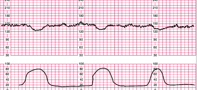 <p>- caused by a vagal response produced when head is compressed by uterine contractions</p><p>- usually don’t see until later in labor at like 7/8; okay then, not really before</p><p>- little scoops of ice cream</p><p>- slowing of FHR starting at beginning of contraction and returning to baseline by end; mimics contractions</p><p>- do not indicate fetal distress, however, can indicate very strong uterine contractions and that head is descending</p><p>- gradual onset &gt; 30 sec from onset to nadir (peak)</p>