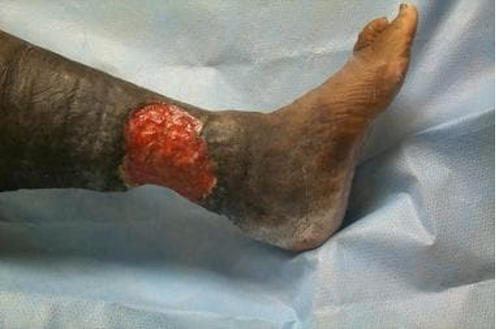 type of ulcer and characteristics?