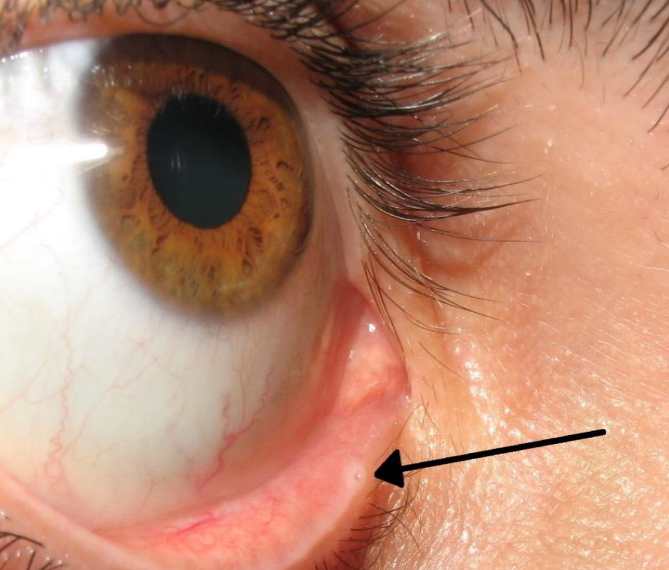 <p>Upper (6mm from inner canthus) and lower punctum (6.5mm from inner canthus)</p><p><u>Do not overlap on eyelid closure</u></p><p>Sit atop<u> papilla lacrimalis</u></p><p>Avascular compared to surrounding tissue</p>