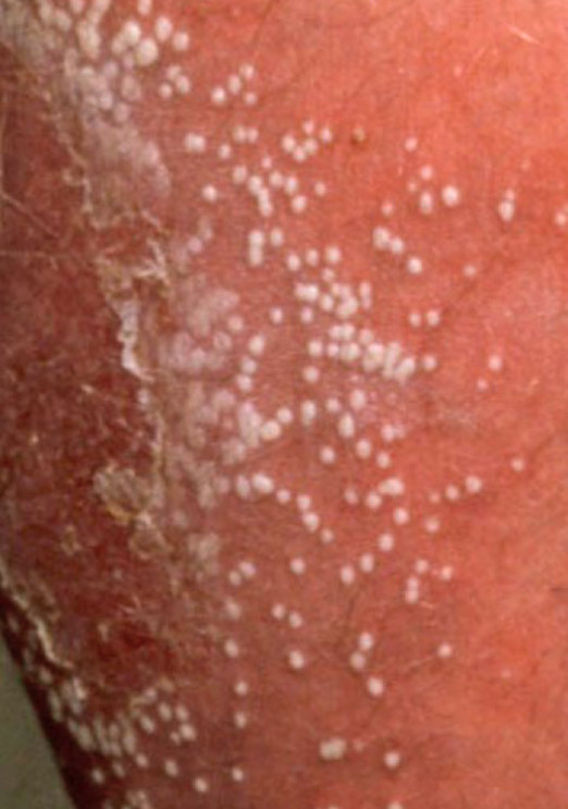 <p>what type of lesion is depicted</p>