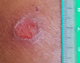 <p>‘Volcanic’ in appearance with a raised border and a central crater</p>