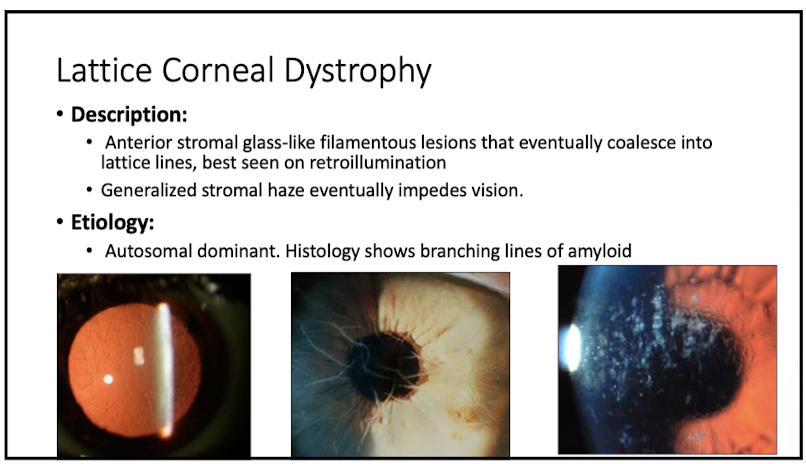 <p>anterior stromal glass-like filamentous lesions that eventually coalesce into lattice lines</p>