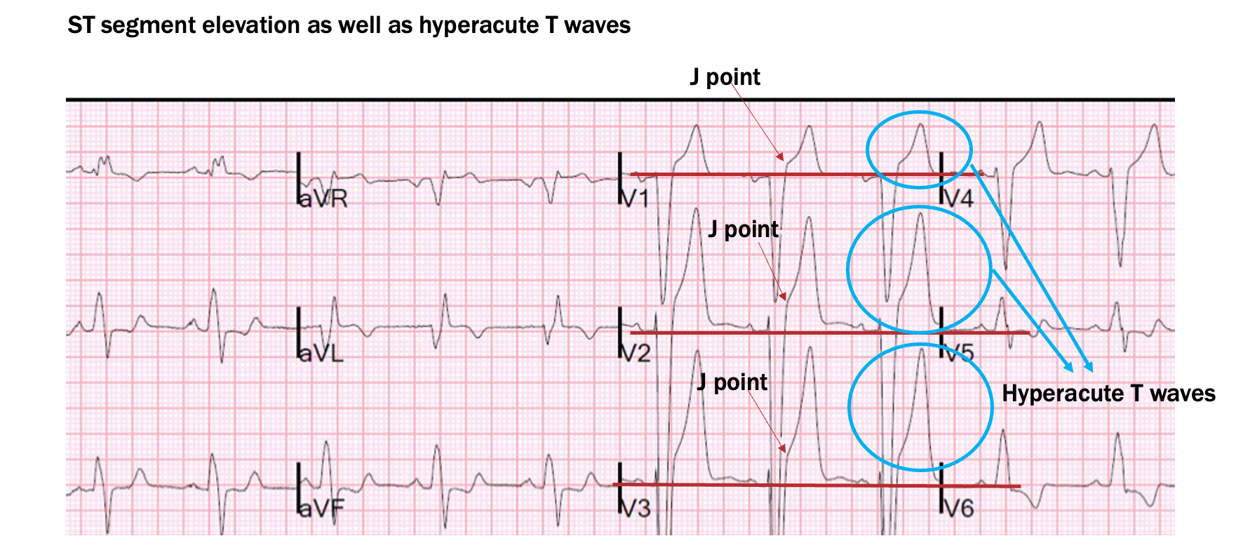 <p>ST seg elevation</p>