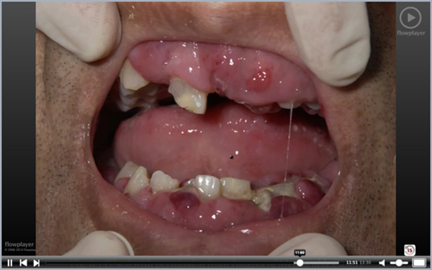 <p>masses in gums</p>