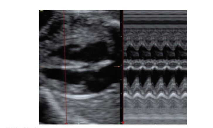 <p>Two-dimensional and M-mode of the ventricular cavities. On the motion mode, time is depicted along the horizontal axis (dots along the top of the image). The distance between two dots represents 1second. Distance is located along the vertical axis. The aorta is shown as the two parallel lines moving as a “unit” through systole (pumping) and diastole (resting).</p>