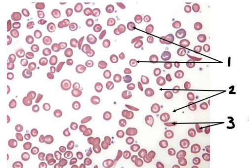 <p>Name this type of blood pathology and it’s structures</p>