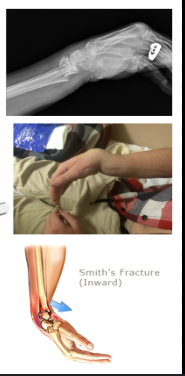 <p>Distal Radius Fracture with <strong>volar displacement </strong></p><p>Non-displaced: Sugar tong splint </p><p>Displaced: reduction, splint </p>
