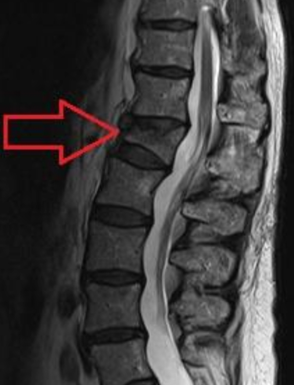 <ul><li><p>the most common type of thoracolumbar fracture</p></li><li><p>Middle column can act as a pivot with a resultant distraction injury in the posterior column - unstable injury</p></li></ul><p></p>