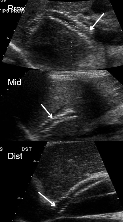 <p>MPV (direction &amp; wavefom) </p><p>PROX : portal end of TIPS (insertion of MPV)</p><p>MID stent </p><p>DISTAL : hepatic venous end, outflow (inserts into IVC)</p><p>portal branches if visualized </p>