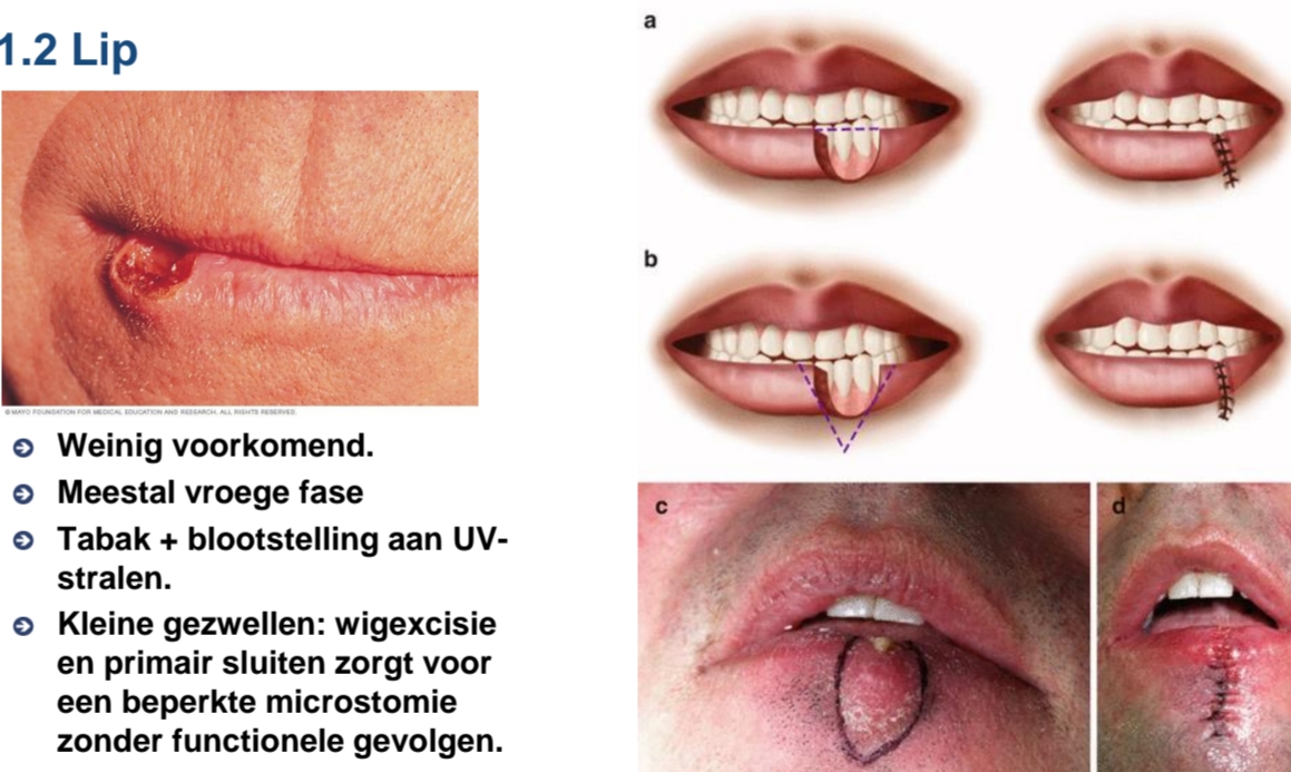 <ul><li><p>Weinig voorkomend.</p></li><li><p>Vooral onderlip, UV-blootstelling = risicofactor.</p></li><li><p>Vaak vroeg ontdekt → goede prognose</p></li><li><p>Kleine gezwellen: wigexcisie en primair sluiten zorgt voor een beperkte microstomie zonder functionele gevolgen.</p></li></ul><p></p>