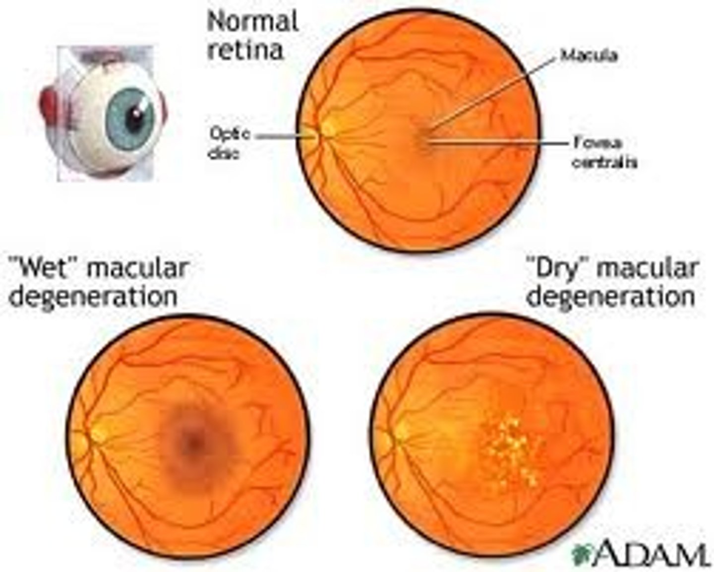 <p>Macular degeneration is a progressive eye condition that affects the central portion of the retina, leading to vision loss. It can be classified as "wet" or "dry."</p>