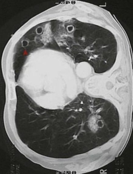 <p>8.11 Side B (PBD9: 388; BP9: 504)<br></p>
<p><br></p>
<p>Questions<br></p>
<p>A 31-year-old woman with lupus on steroids develops cavitary lung lesions.<br></p>
<p><br></p>
<p>1. What fungal infection might this be?<br></p>
<p>2. Why do lesions enhance on CT?<br></p>
<p>3. What disease does this organism cause in asthmatics?<br></p>