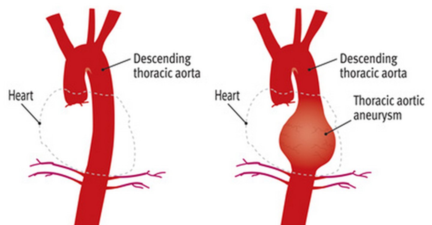 <p>widening of bulging of a blood vessel due to weakening of the vessel wall</p>