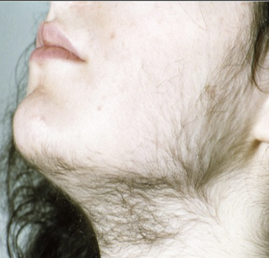 <p>Presence of excessive, dark hair on the forearms and upper lip of women; caused by hormone changes associated with a tumor of the adrenal cortex.</p>