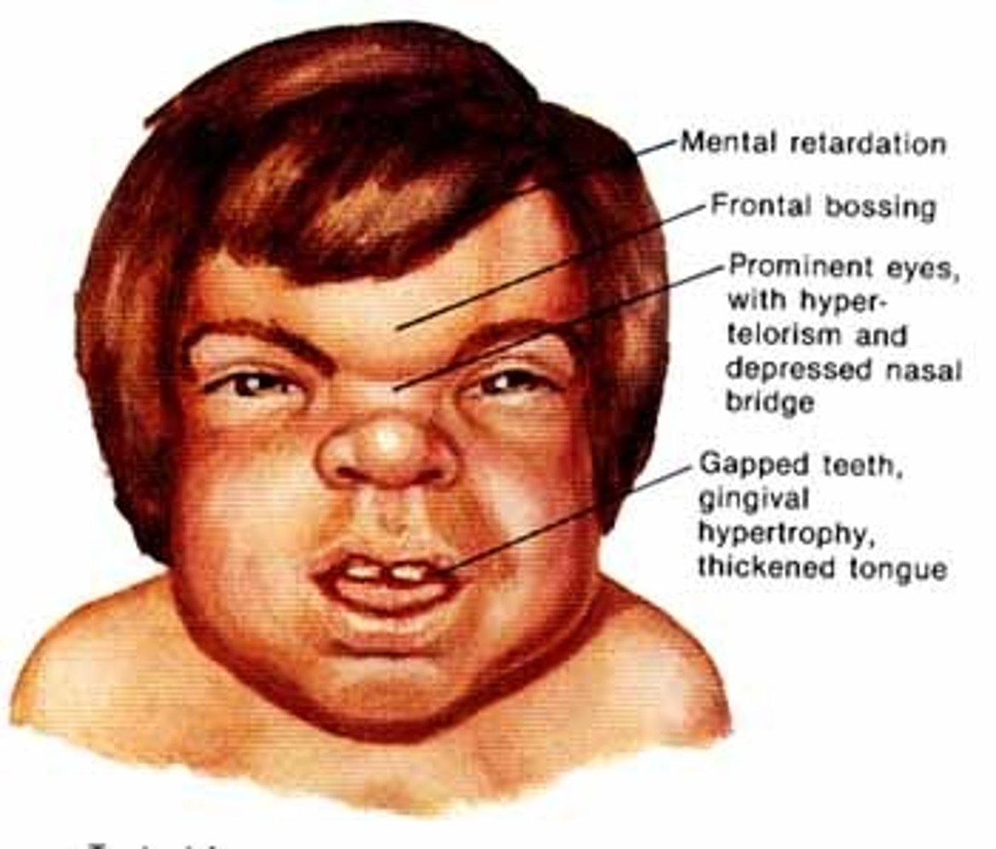 <p>Autosomal recessive deficiency. Most die by age 10.</p><p>Called "gargoylism" in 1800's</p><p>Dwarfism, hunchback, ID, short and thick bones, low nasal bridge, sensorineural deafness, noisy respiration</p><p>Thick lips, large tongue, small, malformed teeth</p><p>Artic problems, vocal fatigue and hoarseness</p>