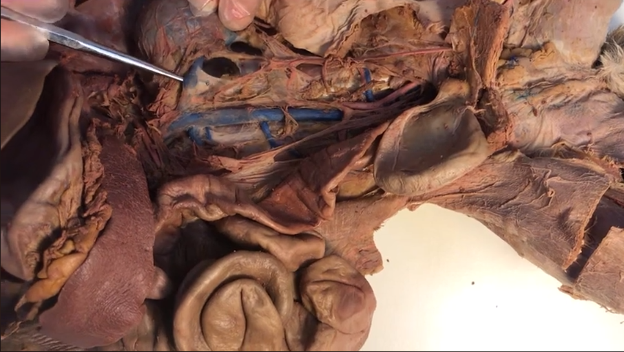 <p>What vein is this</p>