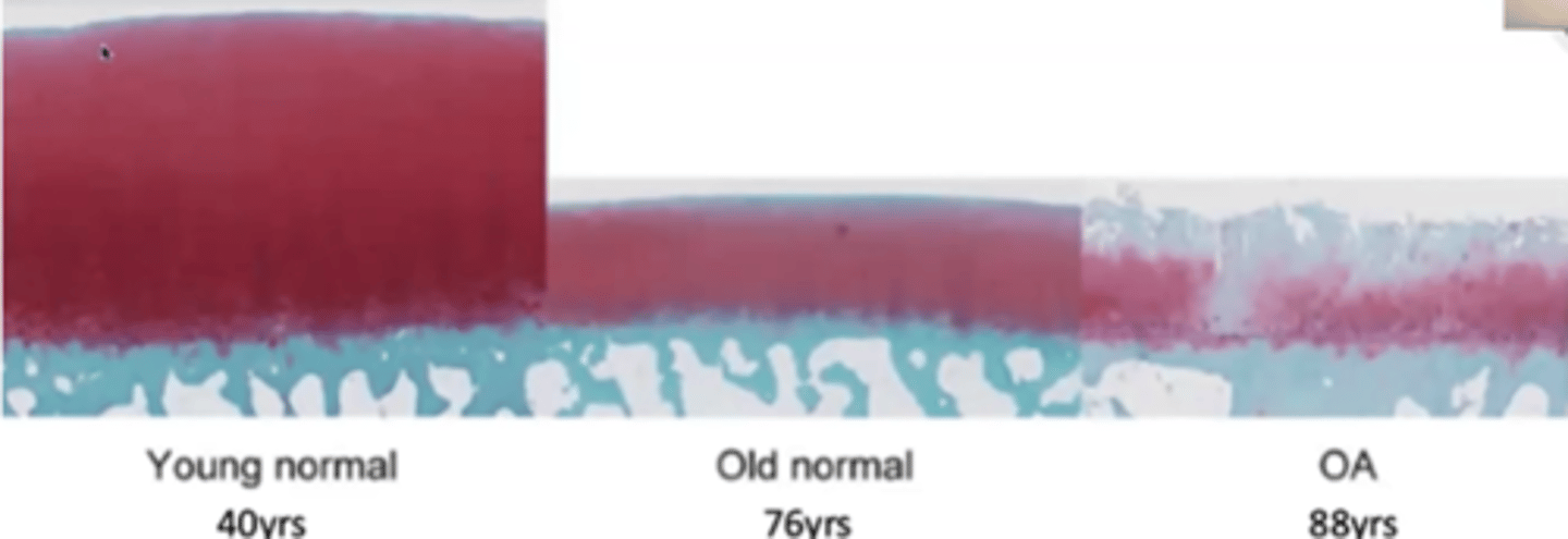<p>-Discoloration due to accumulation of advanced glycation end products (AGEs)</p><p>-Reduced cartilage thickness</p>