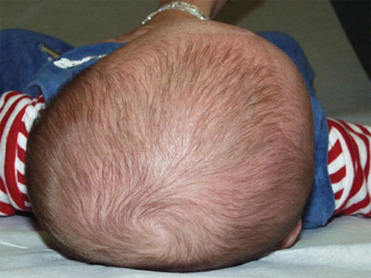 <p>plagiocephaly</p>