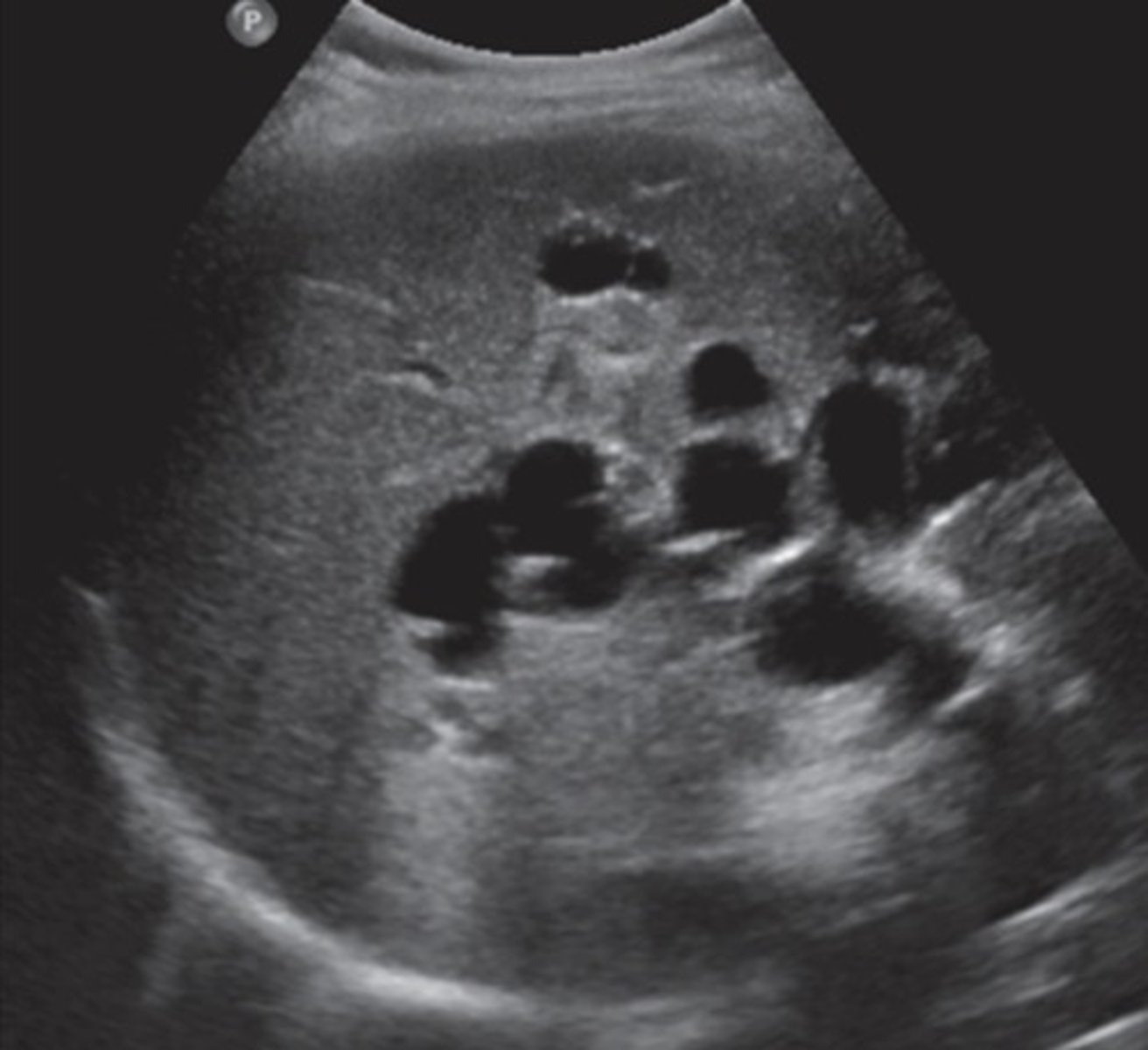 <p>Multiple simple cysts</p><p>No genetic component</p>