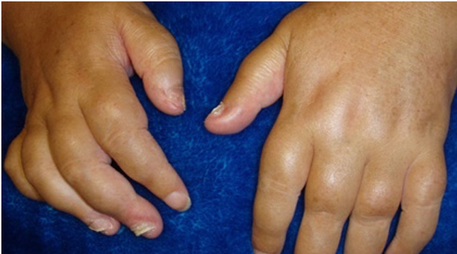<p>A manifestation of Psoriasis/Psoriatic Arthritis</p><p></p>