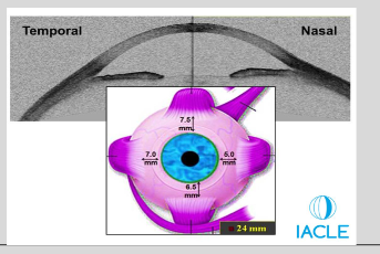 <ul><li><p>Nasal sclera is flatter</p></li><li><p>Space from limbus to muscle insertion:</p><ul><li><p>Temporal: 7.0 mm</p></li><li><p>Superior: 7.5 mm</p></li><li><p>Inferior: 6.5 mm</p></li><li><p>Nasal: only 5.0 mm</p></li></ul></li></ul><p></p>
