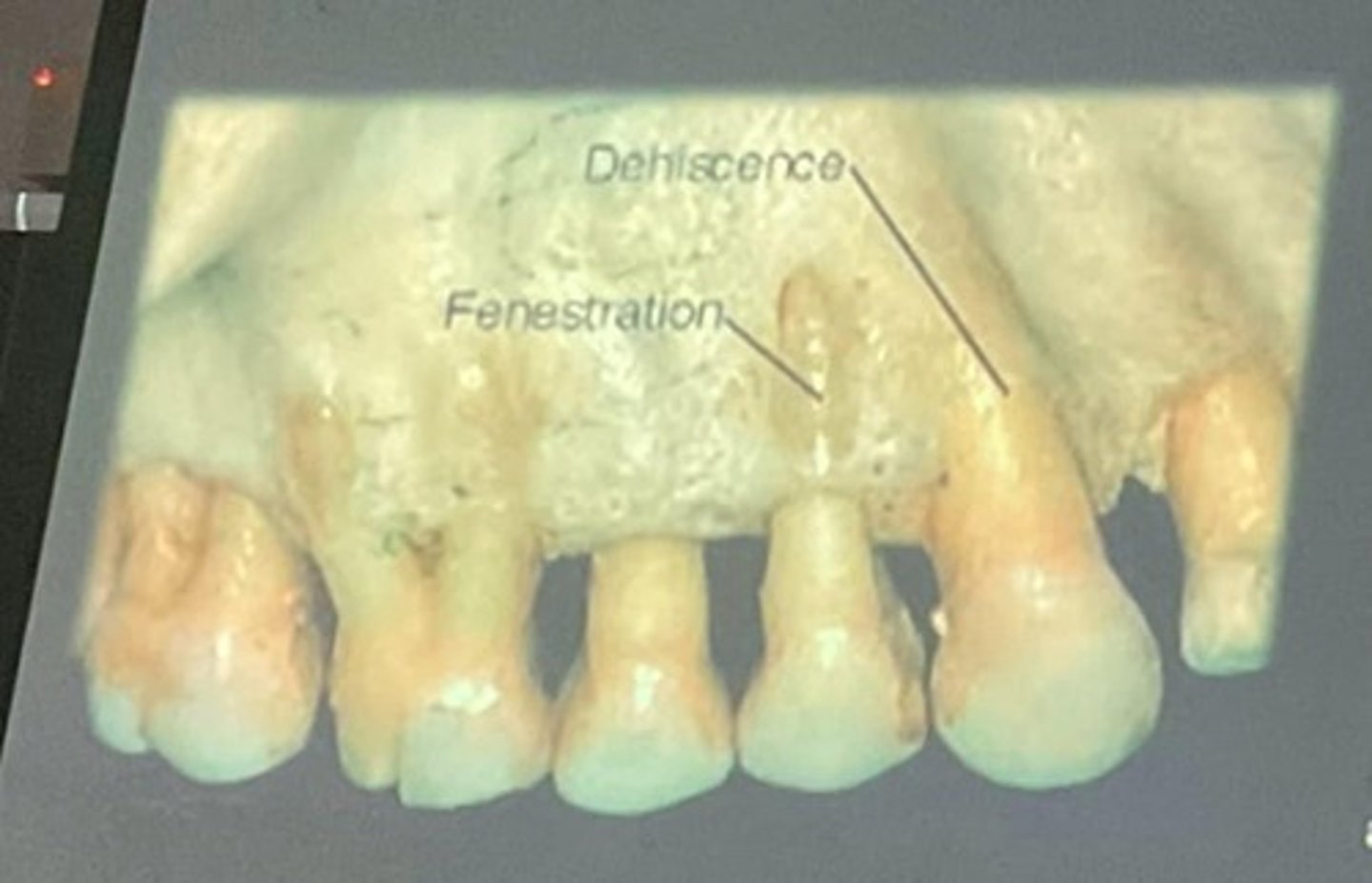 <p>a cleft type partial absence of bone over the root area of a tooth</p>