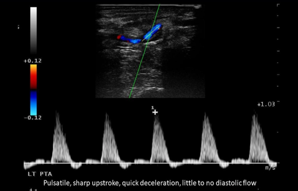 <ol><li><p>Sharp upstroke </p></li><li><p>Rapid deceleration </p></li><li><p>Minimal diastolic flow </p></li><li><p>Diastolic flow reversal </p></li></ol><p></p>