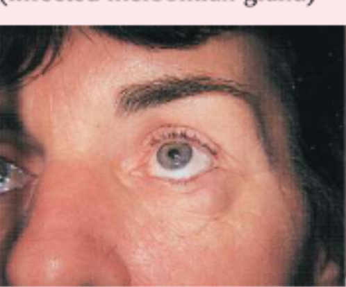 <p>chalazion</p>