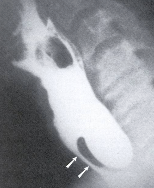 <p>What esophageal disorder is this?</p>