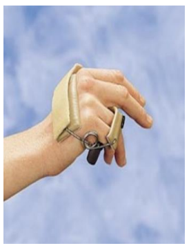 <p>What is the use of a dynamic ulnar nerve splint (aka dynamic anti-claw deformity splint, Wynn Perry Splint)?</p>