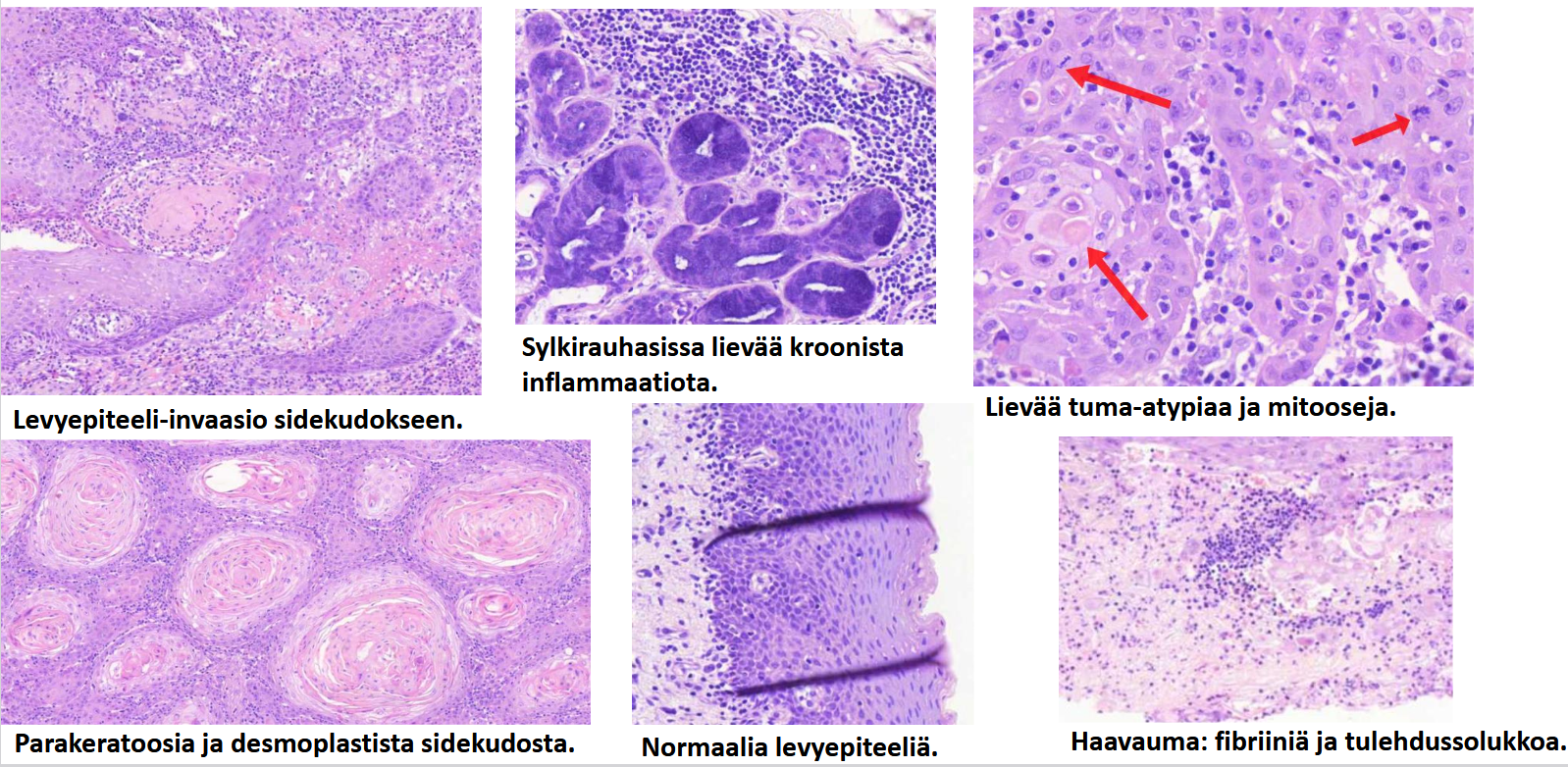 <p>seuraavan kuvan ja tekstien avulla, mikä tauti on kyseessä? </p>