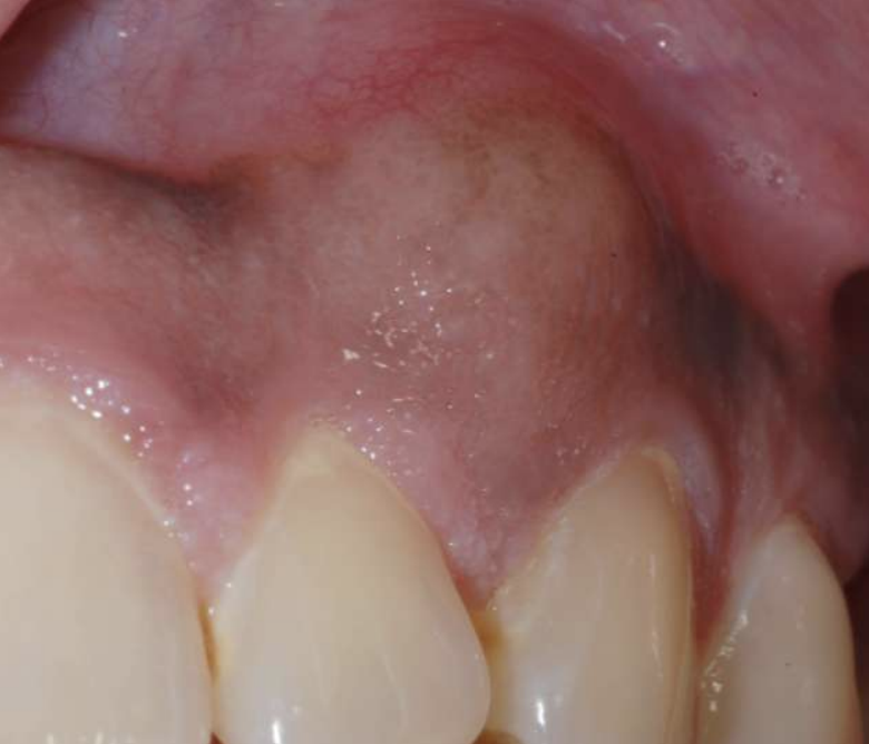 <p>how do Odontogenic Myxoma present symptomatically?</p>
