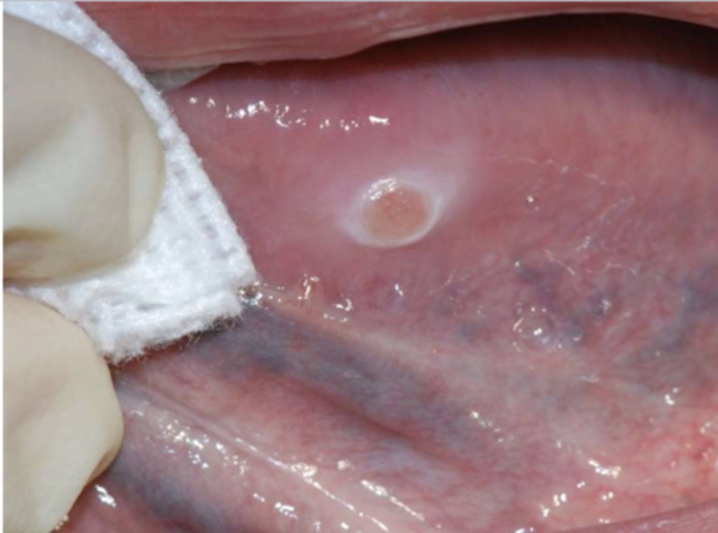 <p>Patient reported that they accidentally burned their tongue a few weeks ago and the sore gets irritated every time they chew. What do you suspect?</p>