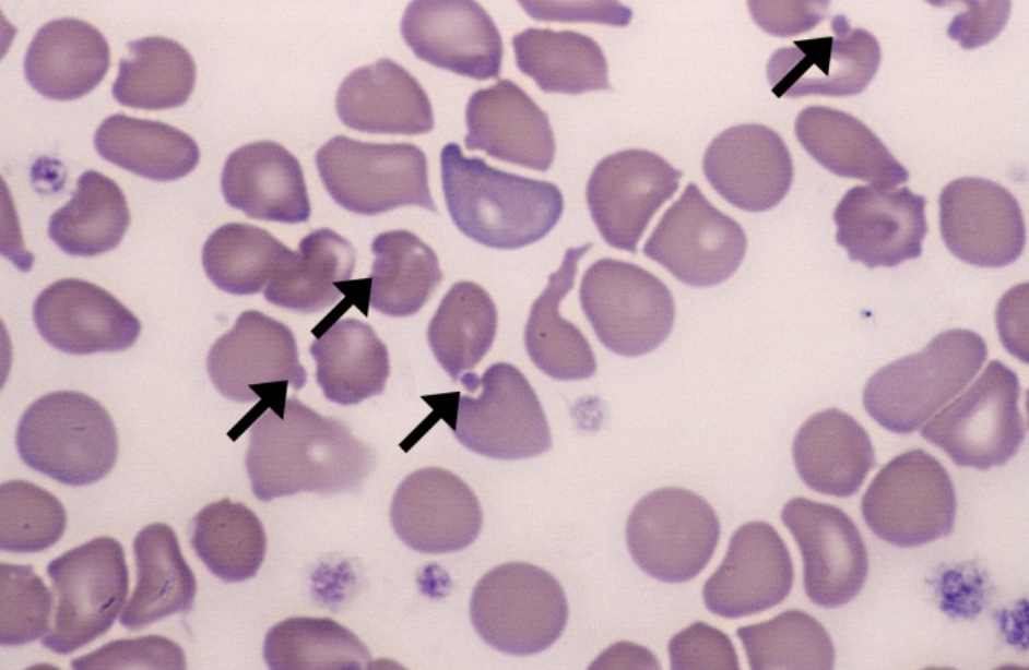 <p>What type of smear cell and what conditions is it seen in</p>