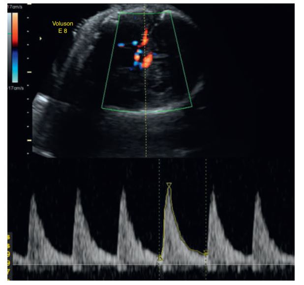 <p>If the peak velocity is 50 cm/sec after 30 weeks of gestation, fetal anemia is mostly indicated (related to IMMUNE HYDROPS)</p><p></p><p></p><p><span data-name="brain" data-type="emoji">🧠</span> <strong>Vessel:</strong></p><p>Middle Cerebral Artery (MCA)</p><p><span data-name="chart_increasing" data-type="emoji">📈</span> <strong>Finding:</strong></p><p>Peak systolic velocity (PSV) = <strong>~50 cm/s after 30 weeks</strong></p><p><span data-name="speech_balloon" data-type="emoji">💬</span> <strong>Interpretation:</strong></p><p>That value is <strong>too high for gestational age</strong>, meaning <strong>increased MCA blood flow velocity</strong>.</p><p><span data-name="rotating_light" data-type="emoji">🚨</span> <strong>Diagnosis indicated:</strong></p><p><strong>Fetal anemia</strong> — commonly due to <strong>immune hydrops</strong> (Rh isoimmunization) or other causes like parvovirus infection.</p><div data-type="horizontalRule"><hr></div><p>So:</p><figure data-type="blockquoteFigure"><div><blockquote><p><span data-name="small_blue_diamond" data-type="emoji">🔹</span> The <em>waveform shape</em> looks normal (no reversed flow, etc.)<br><span data-name="small_blue_diamond" data-type="emoji">🔹</span> But the <em>measured velocity</em> makes it <strong>abnormal</strong> and <strong>clinically significant</strong></p></blockquote><figcaption></figcaption></div></figure><p><strong>Bottom line:</strong><br><span data-name="point_right" data-type="emoji">👉</span> The Doppler waveform is <strong>abnormal because of elevated MCA peak velocity → consistent with fetal anemia.</strong></p><p></p>