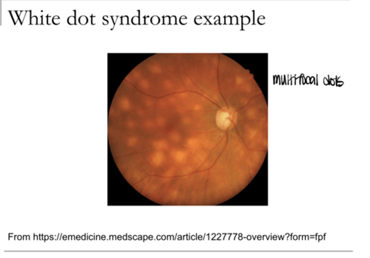 <p>White Dot Syndrome -- Multifocal (Pic)</p>