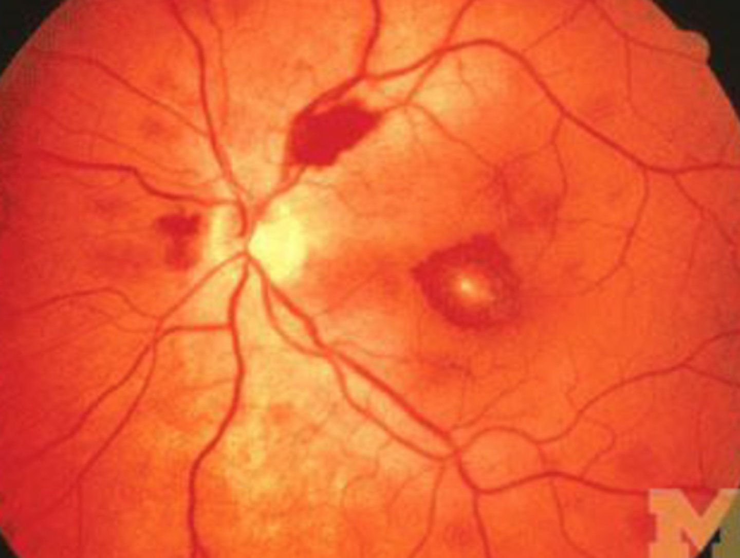 <p>hemorrhagic retinal lesions</p>