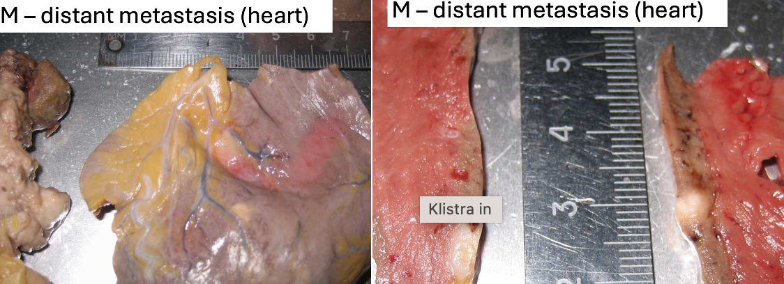 <p><span>Ø</span><span style="font-size: 7pt; font-family: &quot;Times New Roman&quot;">&nbsp; </span><span>Whitish region near coronary artery – metastasis:</span></p><p class="MsoListParagraphCxSpLast"><span>1.</span><span style="font-size: 7pt; font-family: &quot;Times New Roman&quot;">&nbsp;&nbsp;&nbsp;&nbsp; </span><span>Caused obstruction of BV → infarction.</span></p>