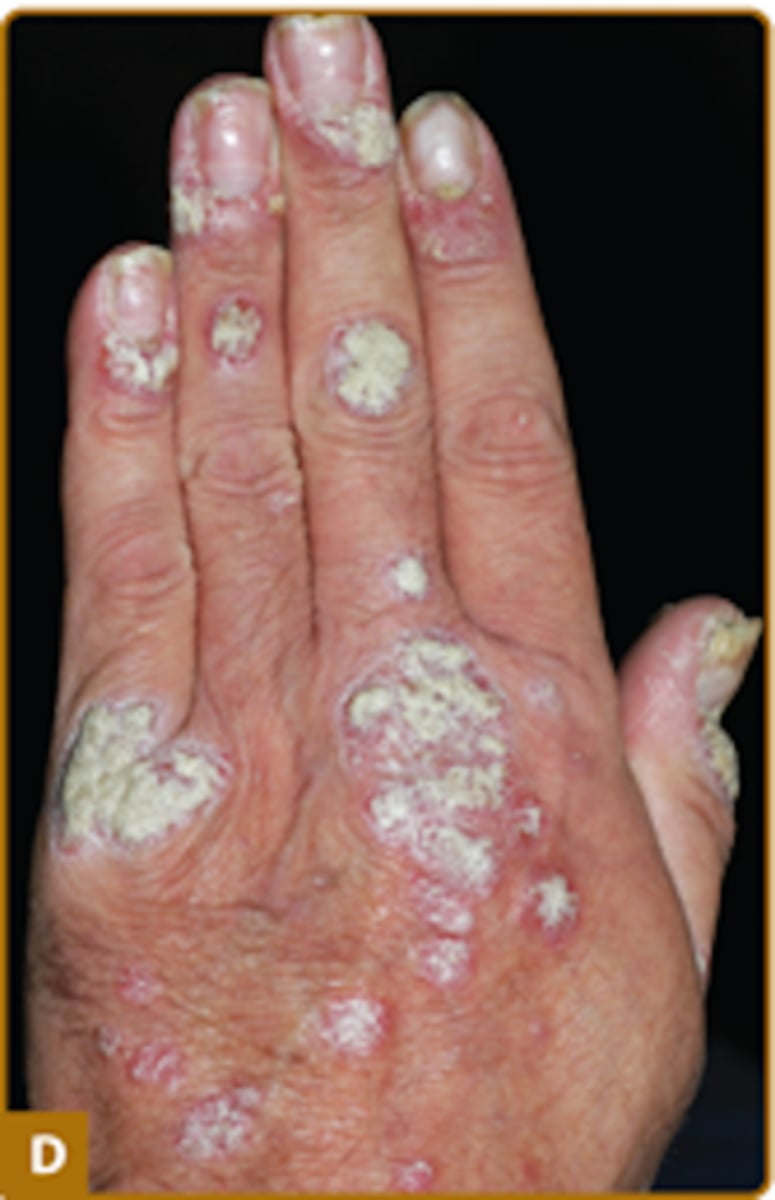 <p>Plaque psoriasis</p>