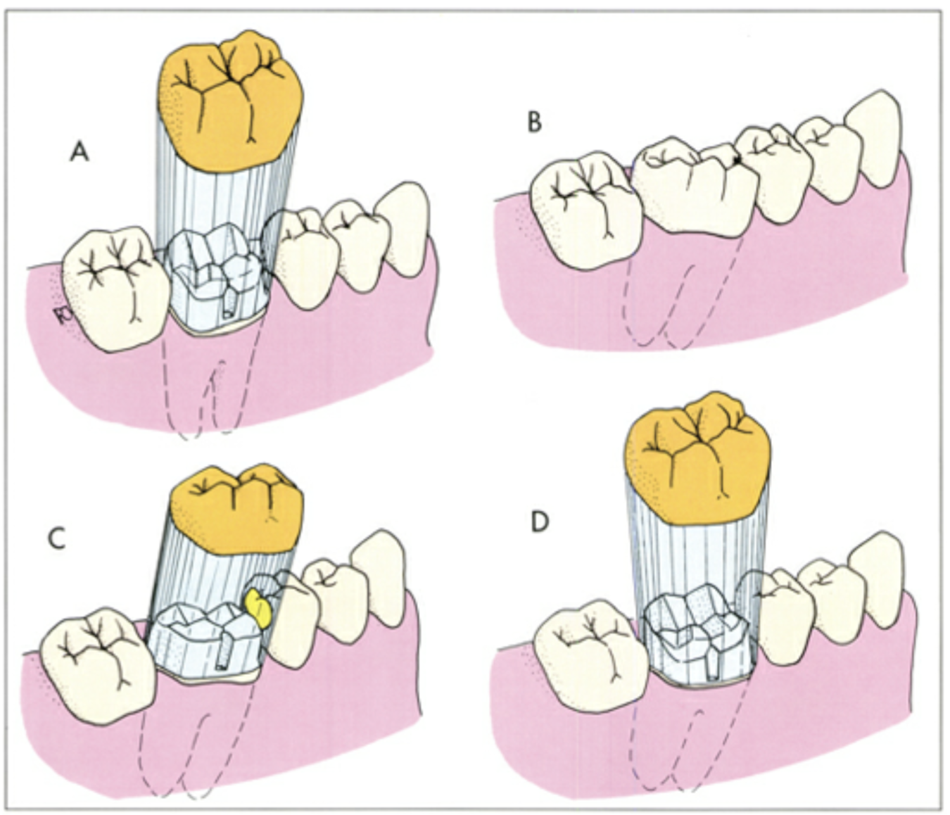 <p>if the tooth was tilted (fig B), then the path of insertion paralleling the long axis of the tooth may be blocked by the proximal contours of the adjacent (fig C) → so path of insertion is made<strong> perpendicular to the occlusal plane</strong> (fig D)</p>