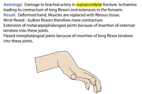 <ul><li><p>supracondylar fracture</p></li><li><p><em>brachial artery </em>damage → ischaemia → contracture (permanent shortening + stiffening) of forearm long flexors and extensors</p></li><li><p>deformed hand → <em>muscles replaced with fibrous tissue</em> → wrist flexed</p></li><li><p>extension of metacarpophalangeal joints + flexion of interphalangeal joints</p></li></ul><p></p>