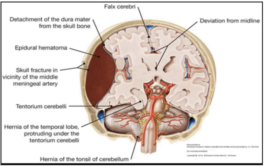 <p><strong>Temporo-parietal region</strong>; <strong>middle meningeal artery; </strong>66% of cases</p>