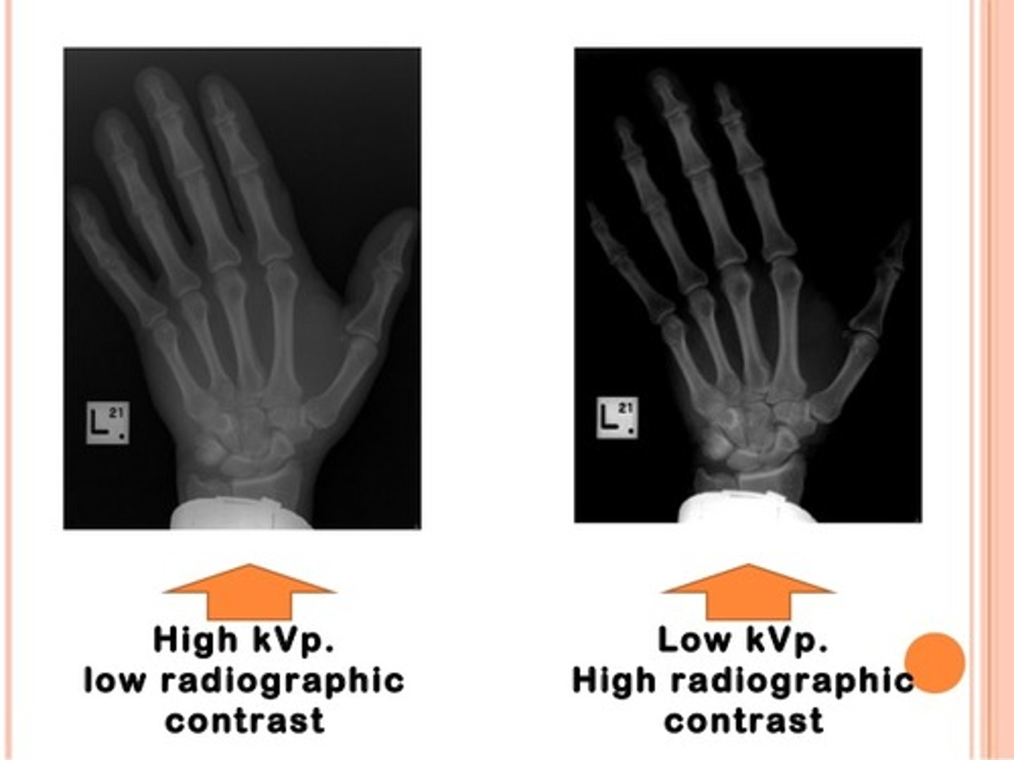 <p>- Decreases penetrating power of the beam<br>- May cause insufficient number if x-rays to reach film/IR</p>