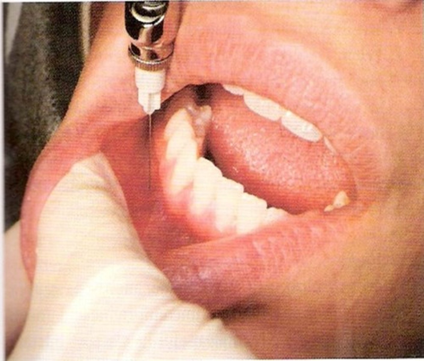 <p>anterior to mental foramen at depth of mandibular mucobuccal fold</p>