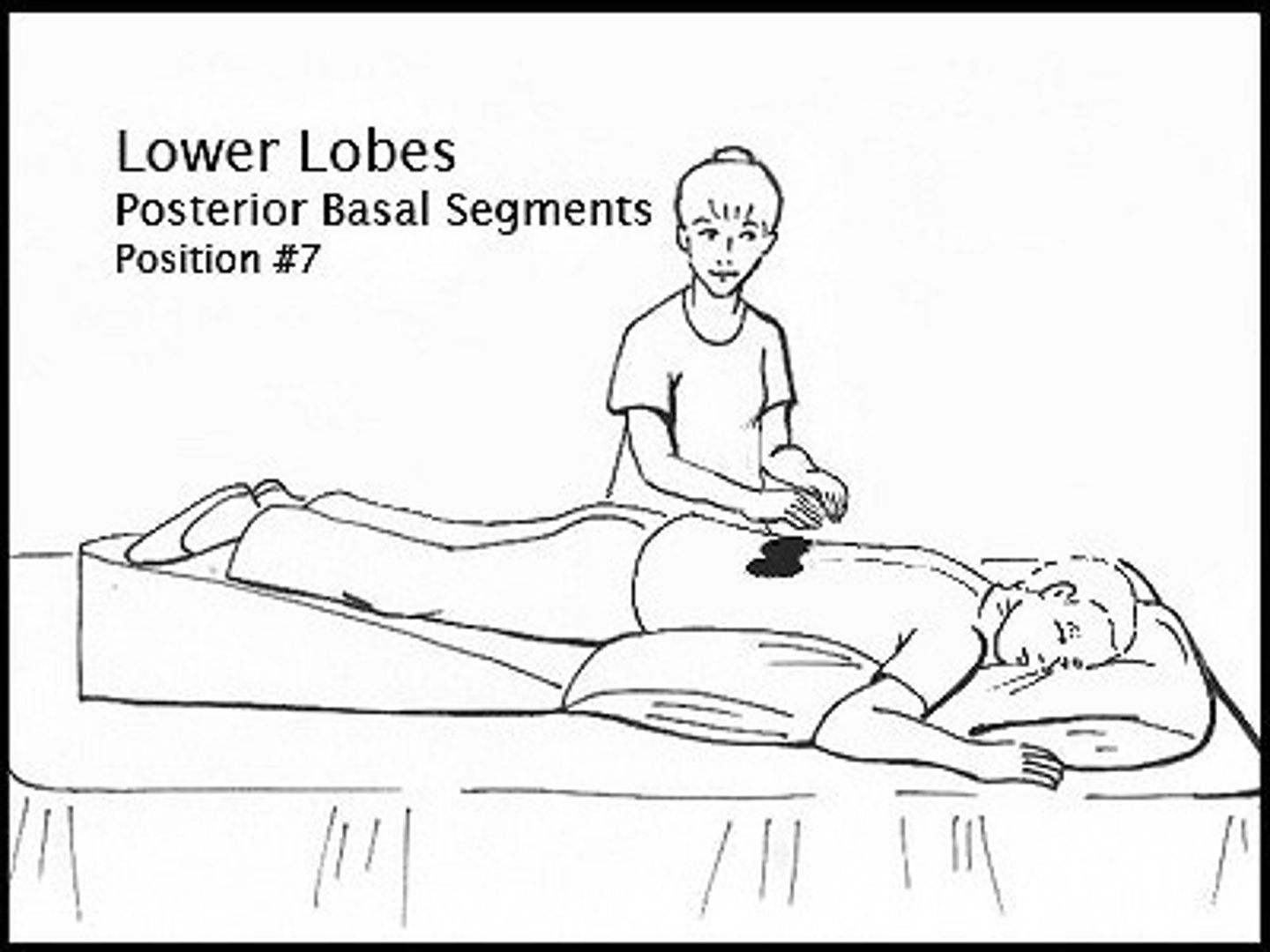 <p>*Patient position*: table elevated 20''. Patient lays down on abdomen, head down, and pillows under hips.</p><p>*PT*: percussion over lower ribs closer to spine.</p>