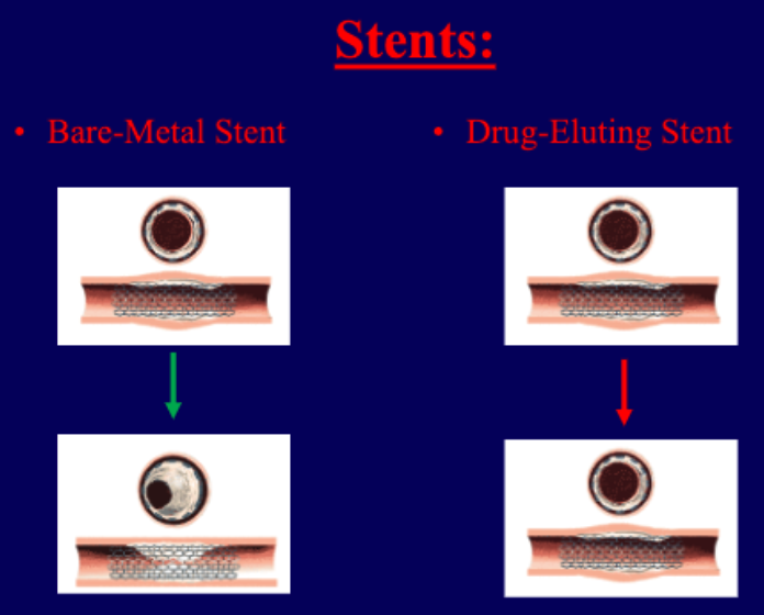 <ul><li><p>bare-metal stent</p><ul><li><p>can sometimes cause excessive wound healing that can block artery</p></li></ul></li><li><p>drug-eluting</p><ul><li><p>can prevent excessive wound healing but sometimes more likely to develop thrombus (anti-platelet meds needed)</p></li></ul></li></ul><p></p>