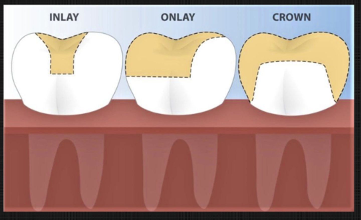 <p>partial coverage restoration for 1+ cusps and adjoining occlusal surfaces or entire occlusal surface and is retained by mechanical or adhesive means</p>