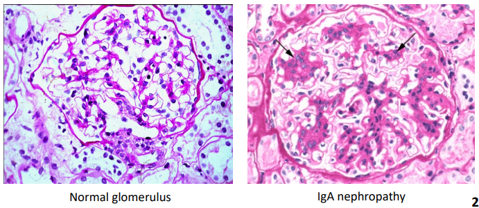 <p>Compare the glomeruli in these light microscopy images:</p><ul><li><p>Segmental areas of increased mesangial cell matrix</p></li></ul><p></p>