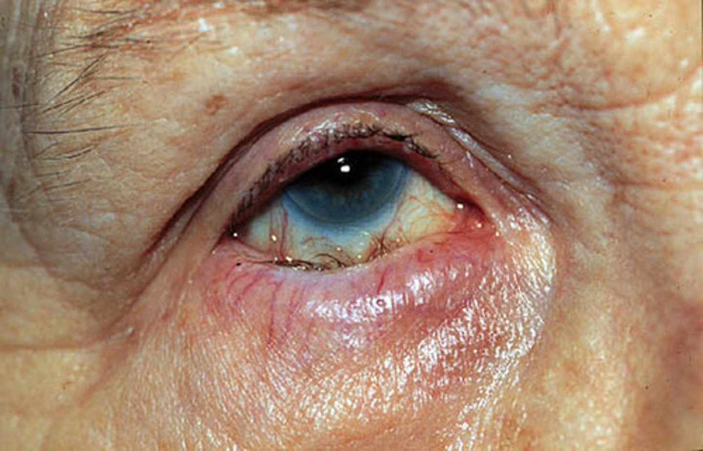 <p>Entropion occurs when the eyelid turns in (inversion)</p>