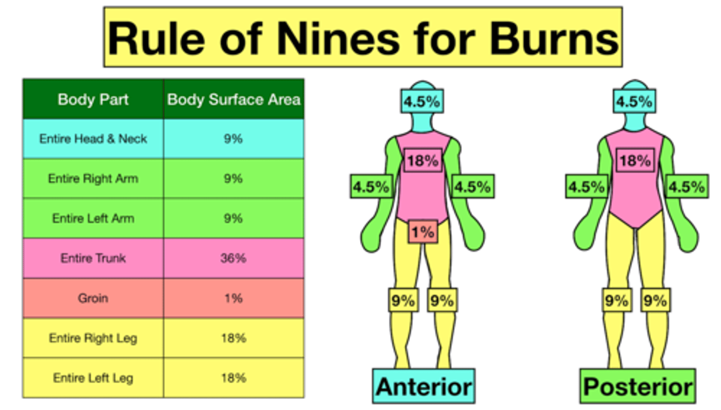 <p>Calculations for assessing percentage of body surface burned.</p>